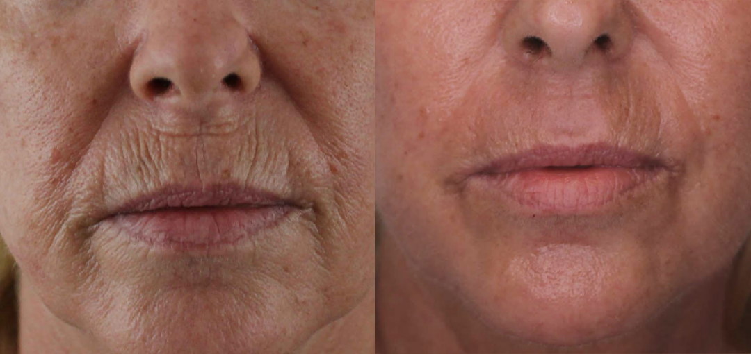 Laser Resurfacing treatment cutis dermatology brisbane 62