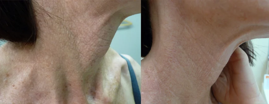 Laser Resurfacing treatment cutis dermatology brisbane 63