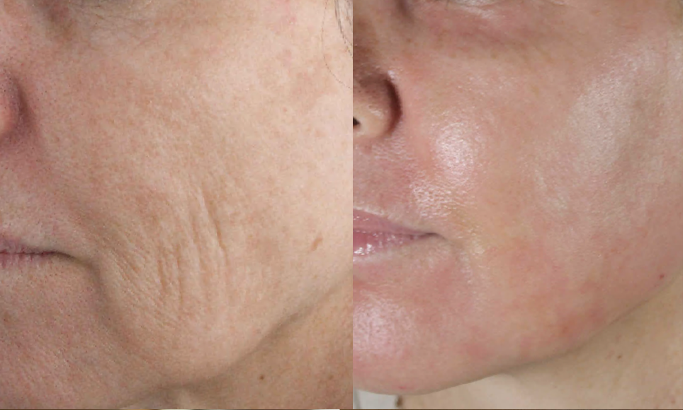 Laser Resurfacing treatment cutis dermatology brisbane 65