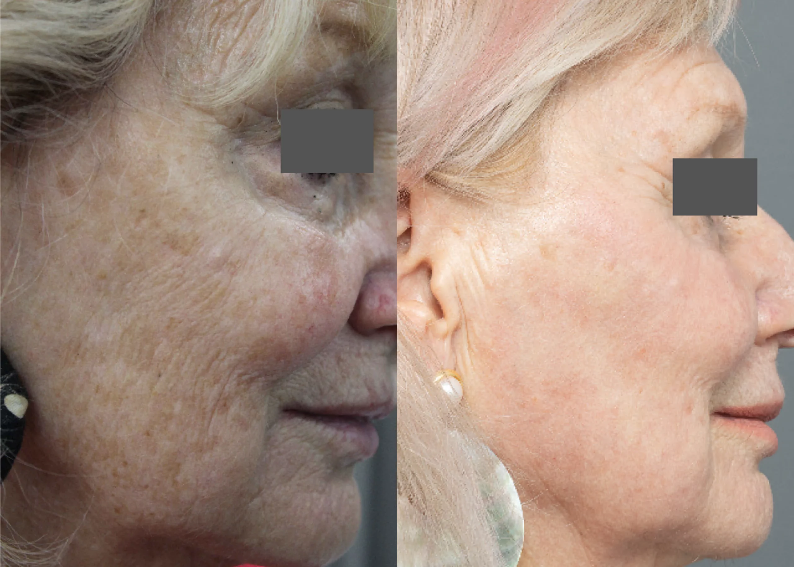 Laser Resurfacing treatment cutis dermatology brisbane 66 scaled