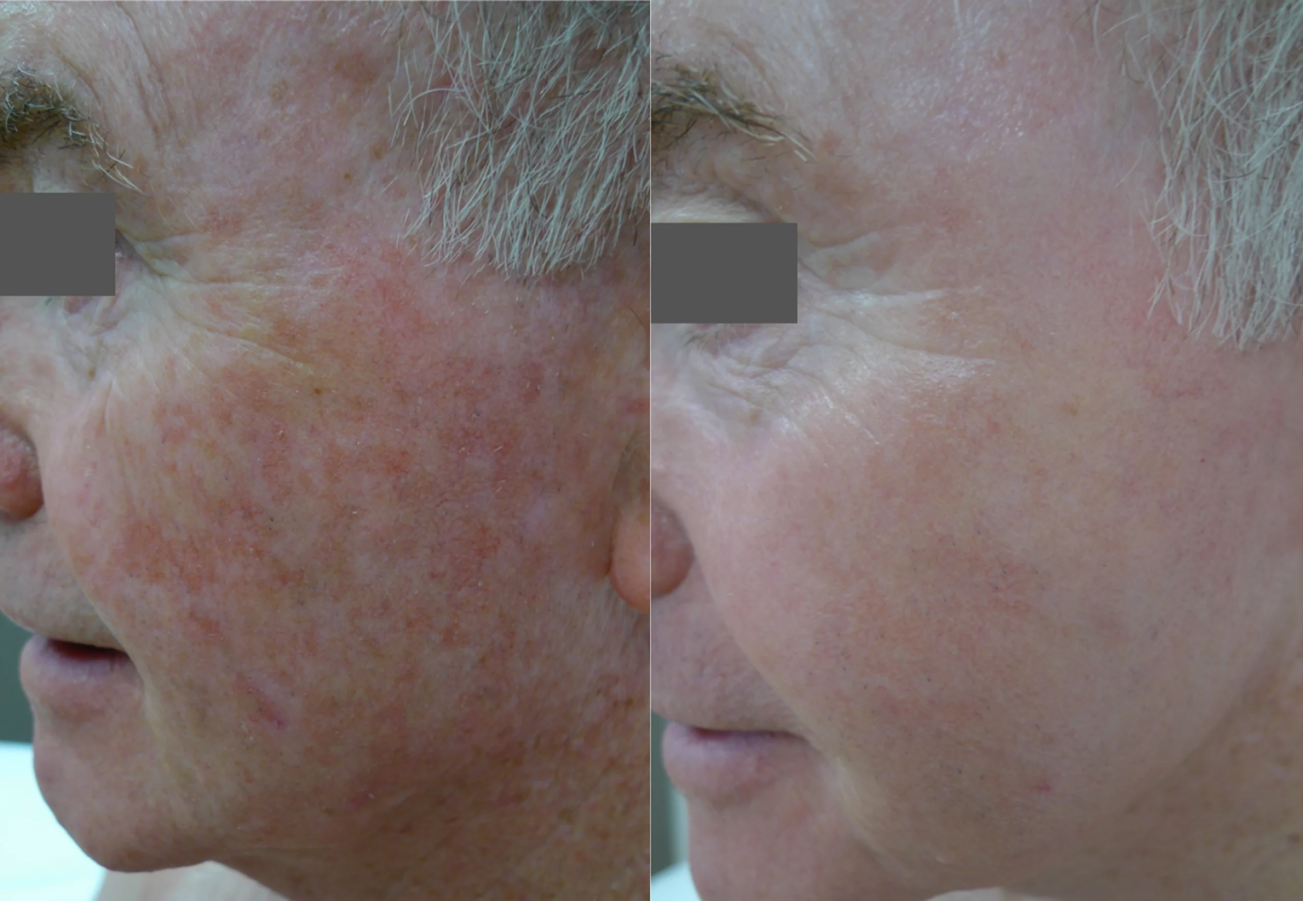 Laser Resurfacing treatment cutis dermatology brisbane 67 scaled