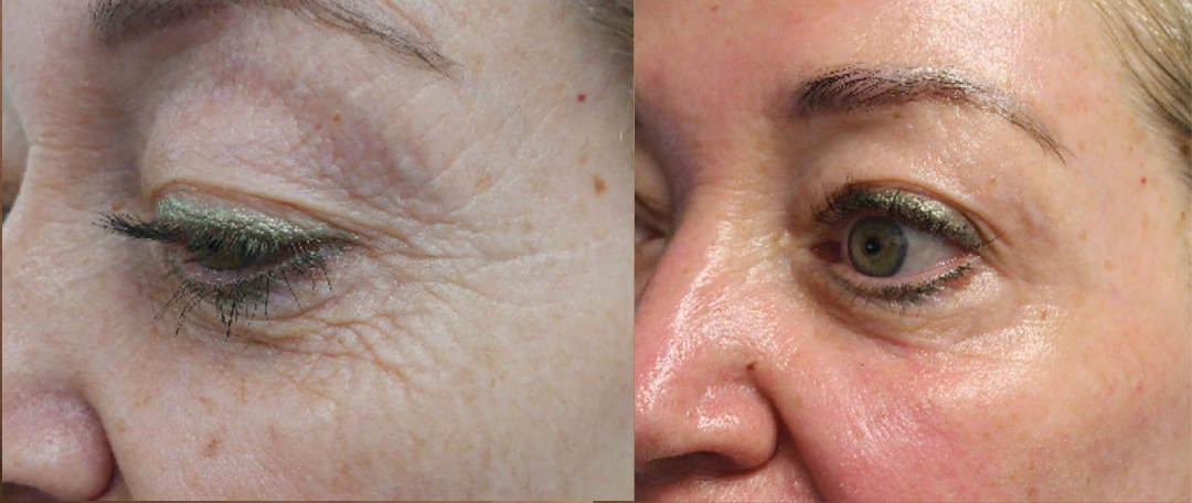 Laser Resurfacing treatment cutis dermatology brisbane 70