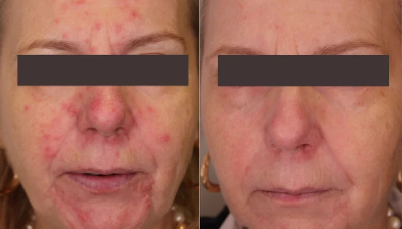 Laser Resurfacing treatment cutis dermatology brisbane 81