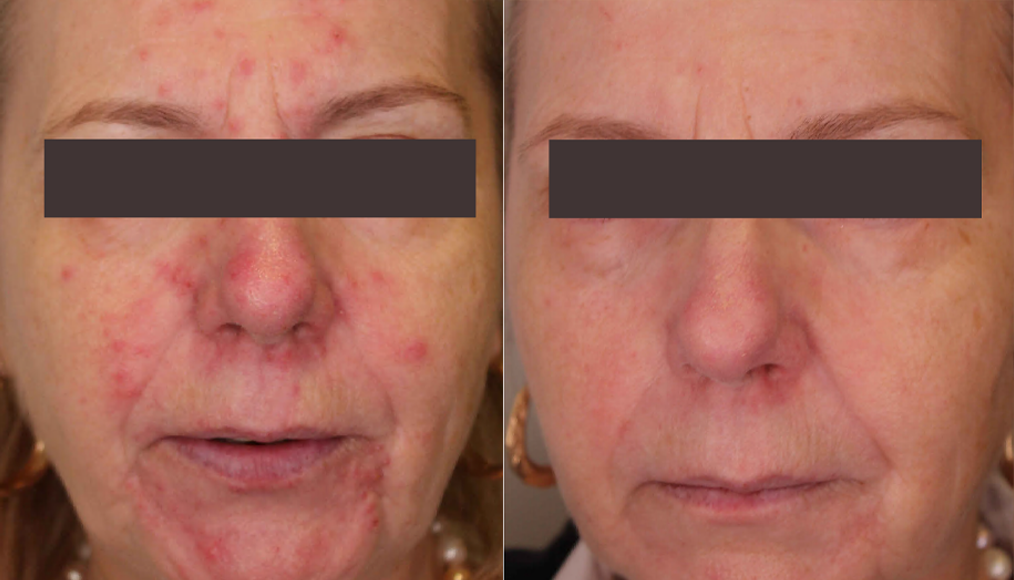 Laser Resurfacing treatment cutis dermatology brisbane 81