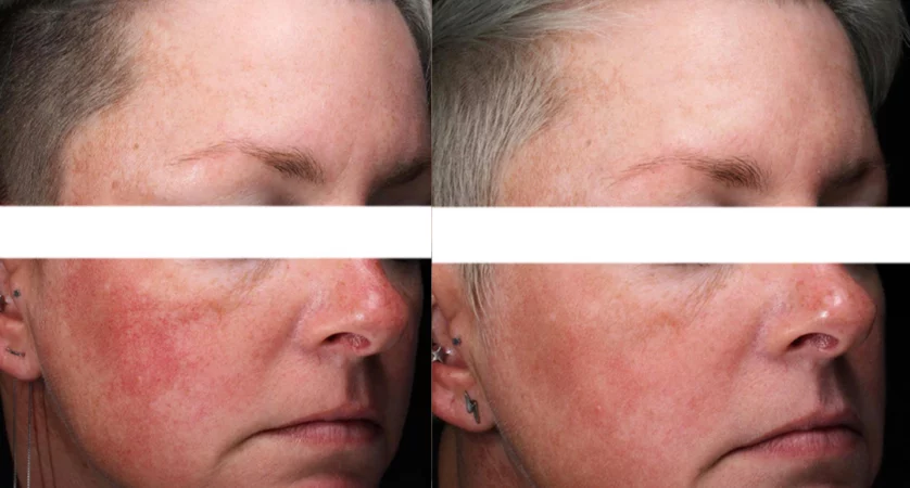 Laser Resurfacing treatment cutis dermatology brisbane 82
