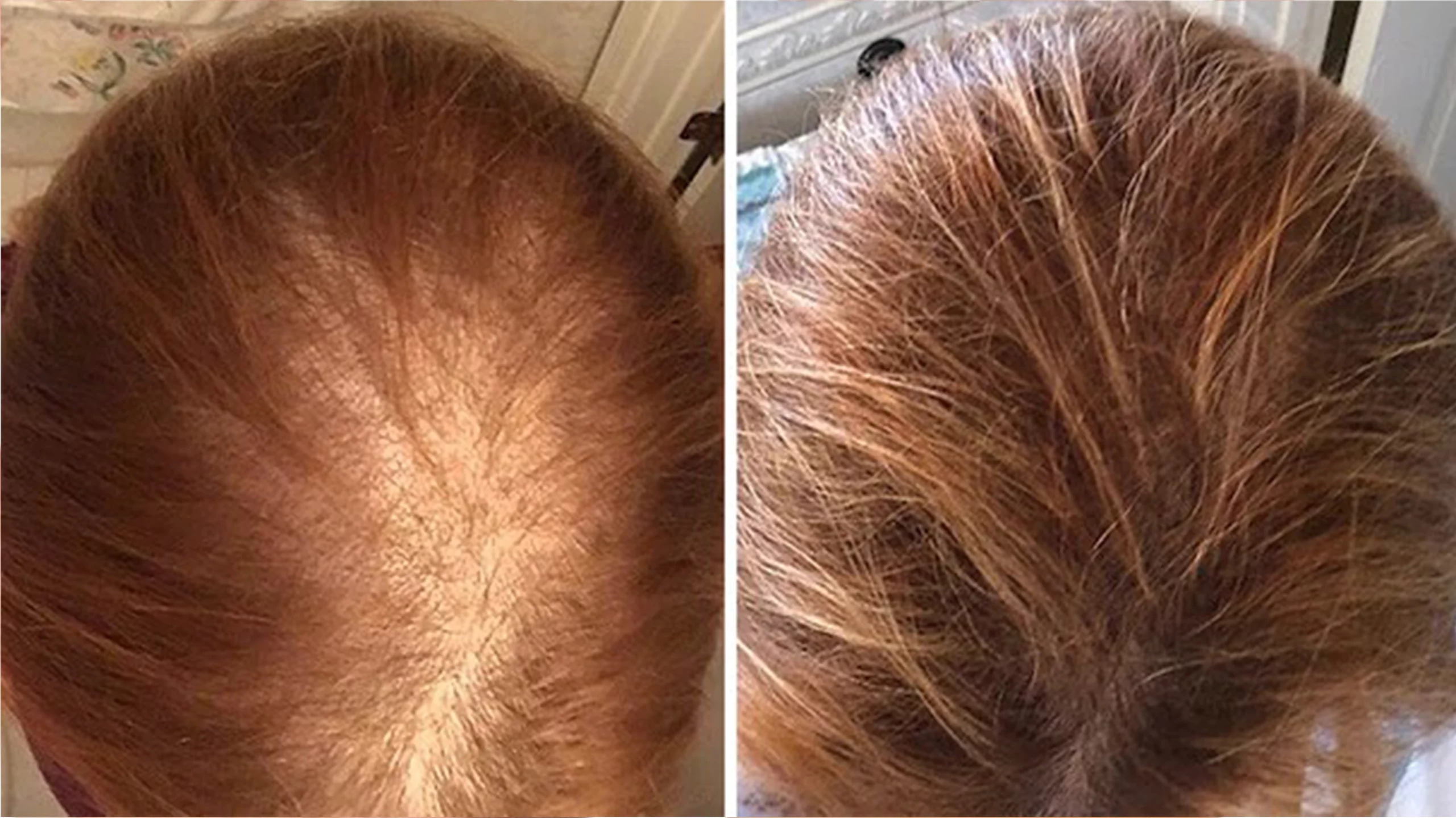 Laser hair restoration cutis dermatology brisbane scaled
