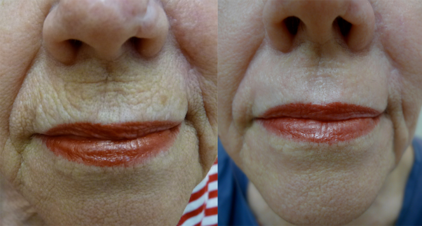 Lip Rejuvenation treatment cutis dermatology brisbane 1
