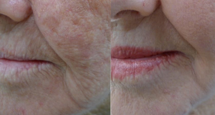 Lip Rejuvenation treatment cutis dermatology brisbane