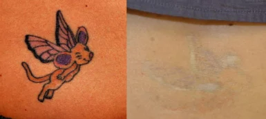 McCoy.Lindsay prepost tattoo treatment cutis dermatology brisbane