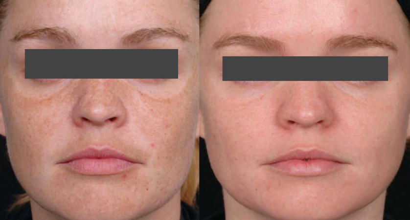 Melasma skincare melasma 1