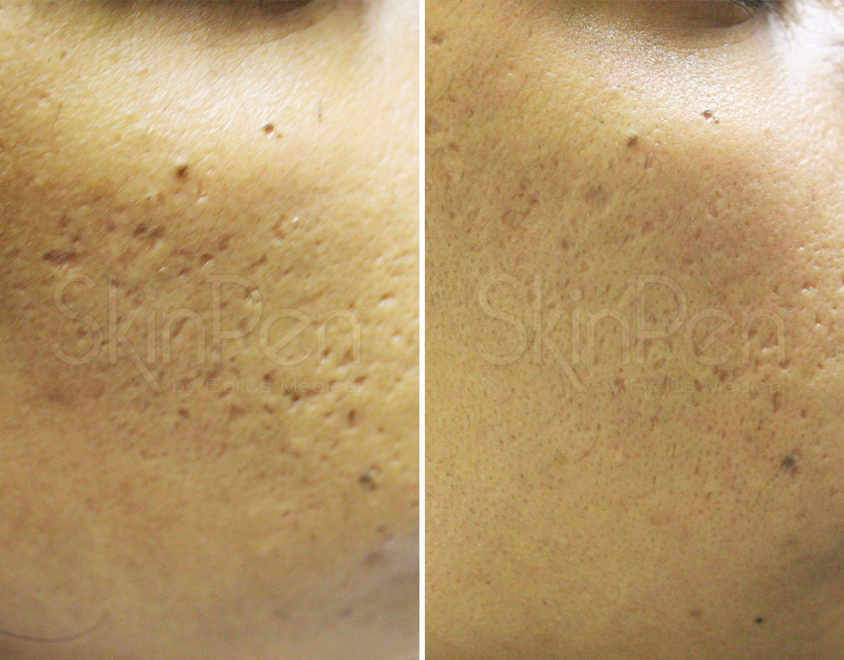 Microneedling acne scars treatment cutis dermatology brisbane 1