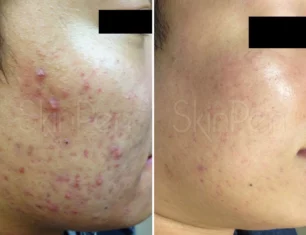 Microneedling acne scars treatment cutis dermatology brisbane