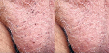 Multiple angiokeratomas on the left side of the scrotum laser cutis dermatology brisbane scaled