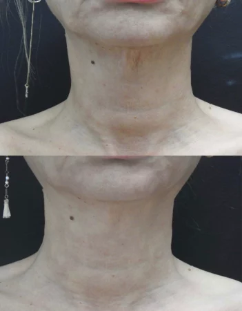 Neck tightening treatment cutis dermatology brisbane