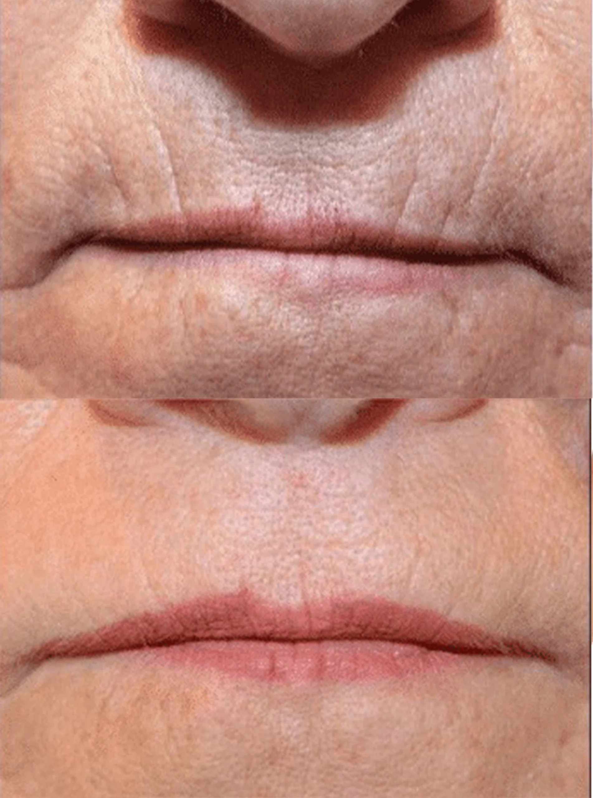 Perioral Lip rejuvenation treatment cutis dermatology brisbane 10 scaled