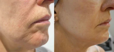 Perioral Lip rejuvenation treatment cutis dermatology brisbane 4 scaled