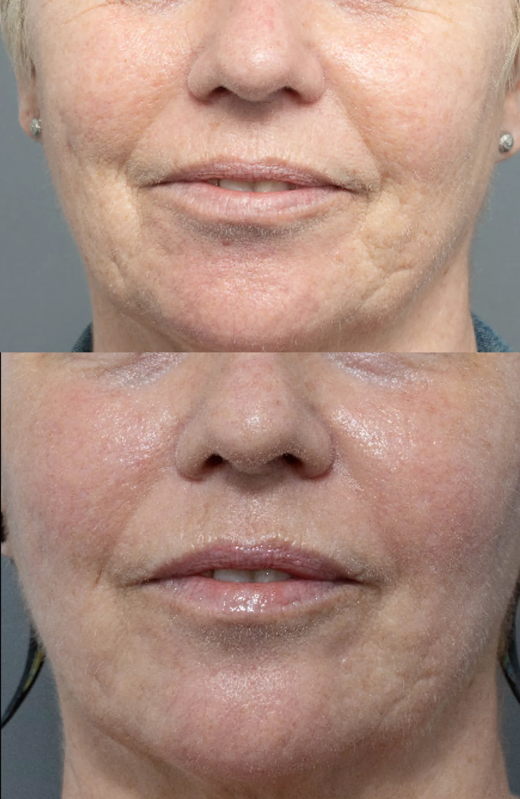 Perioral Lip rejuvenation treatment cutis dermatology brisbane 5 scaled