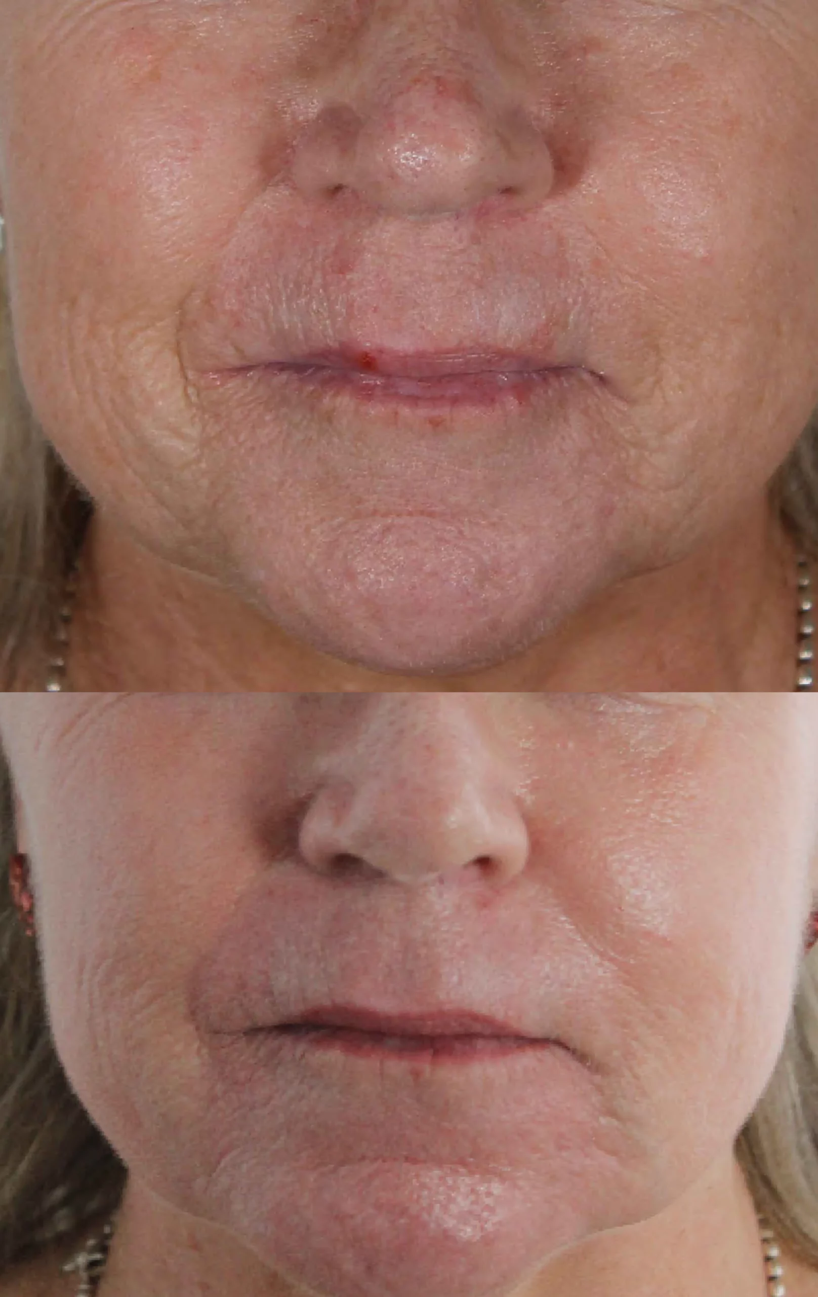 Perioral Lip rejuvenation treatment cutis dermatology brisbane 6 scaled