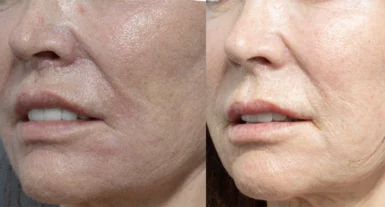 Perioral   Lip rejuvenation treatment cutis dermatology brisbane 1