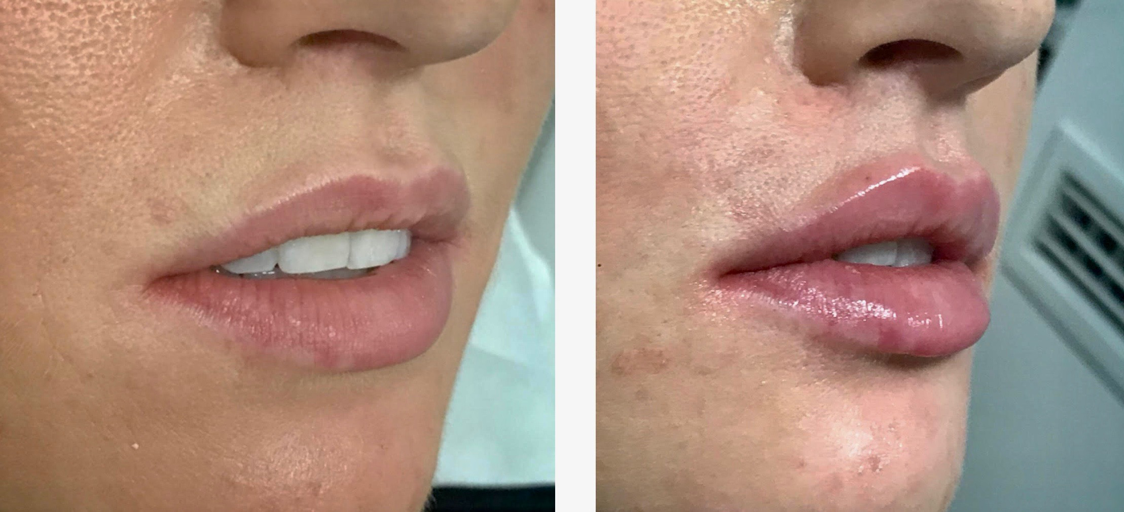 Perioral   Lip rejuvenation treatment cutis dermatology brisbane 10