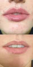 Perioral   Lip rejuvenation treatment cutis dermatology brisbane 11 scaled
