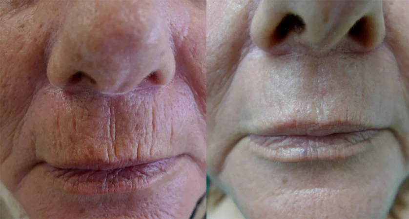 Perioral   Lip rejuvenation treatment cutis dermatology brisbane 2
