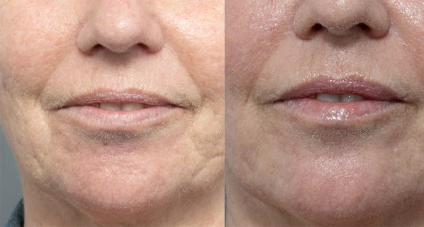 Perioral   Lip rejuvenation treatment cutis dermatology brisbane 4
