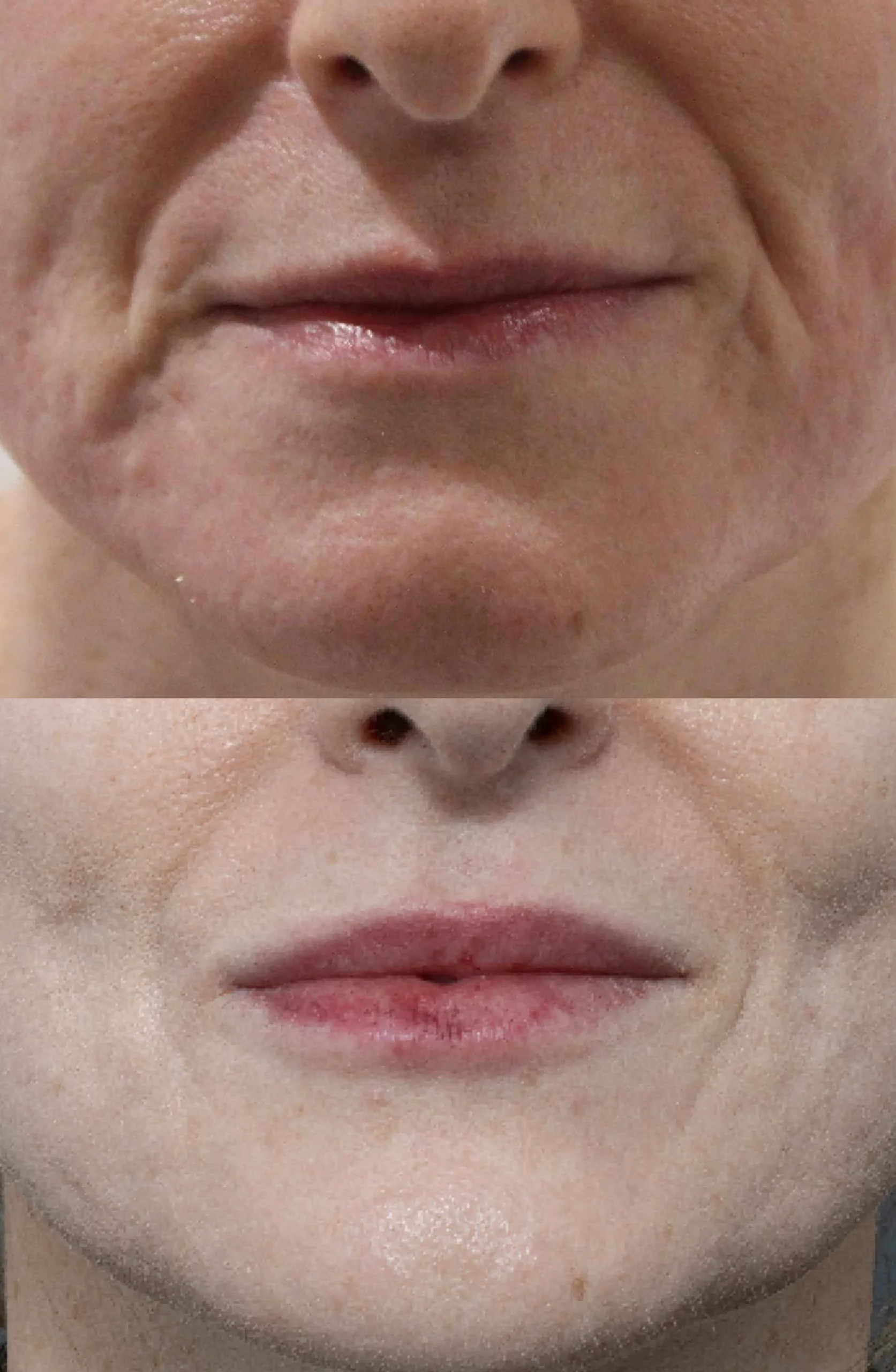 Perioral   Lip rejuvenation treatment cutis dermatology brisbane 5 scaled