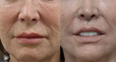 Perioral   Lip rejuvenation treatment cutis dermatology brisbane 6