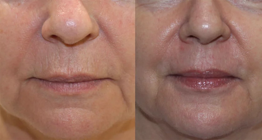 Perioral   Lip rejuvenation treatment cutis dermatology brisbane