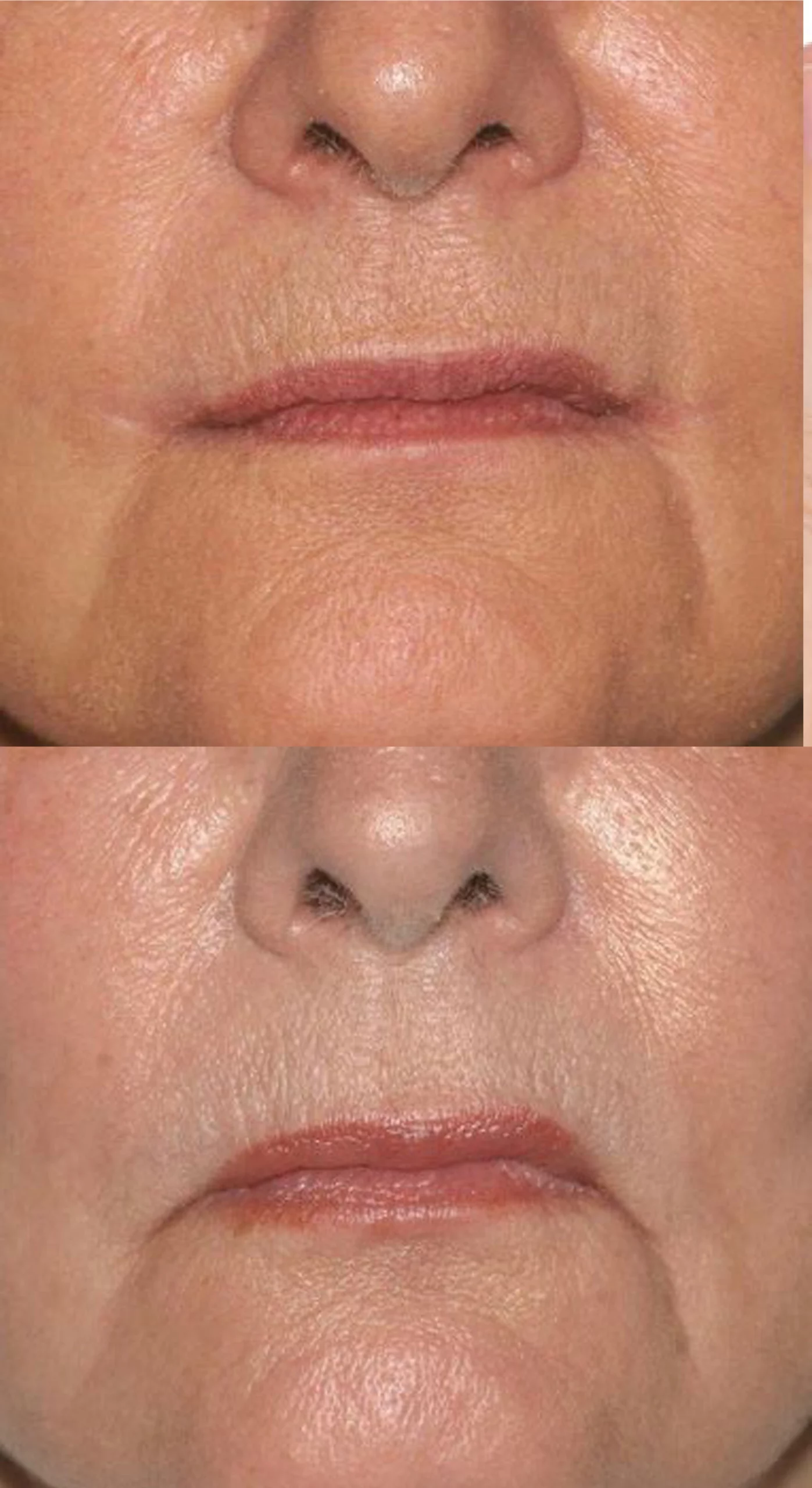 Perioral   Lip rejuvenation treatment cutis dermatology brisbane 9 scaled
