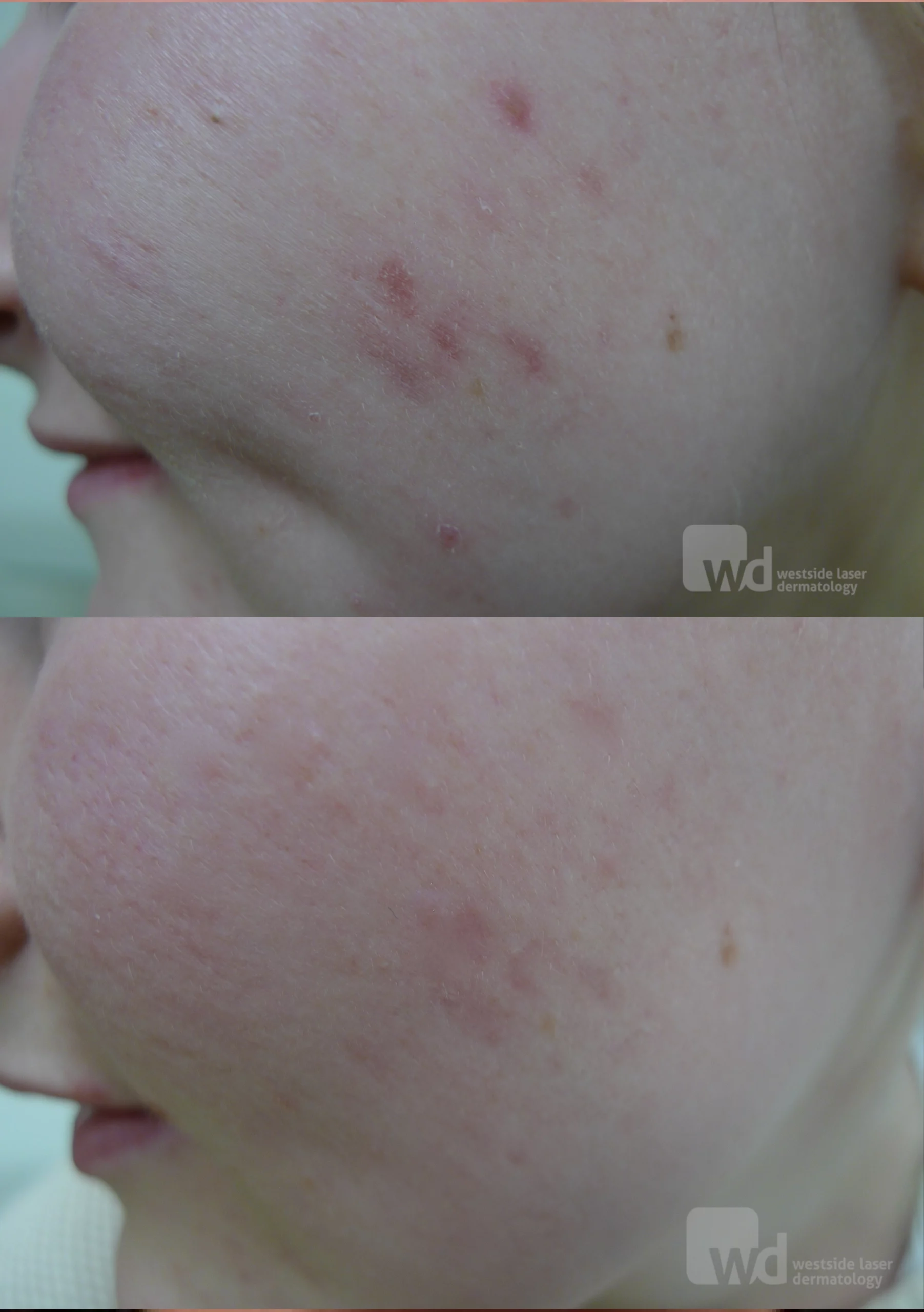 Red acne scars treatment cutis dermatology brisbane 1 scaled