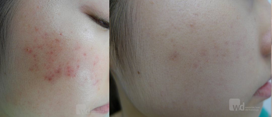 Red acne scars treatment cutis dermatology brisbane 2