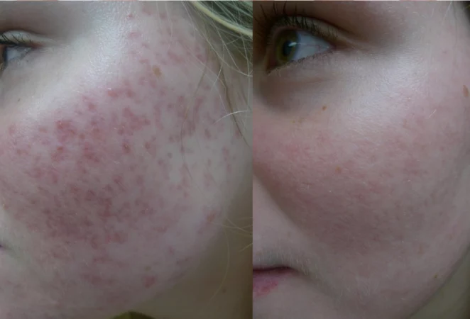 Red acne scars treatment cutis dermatology brisbane 3 scaled