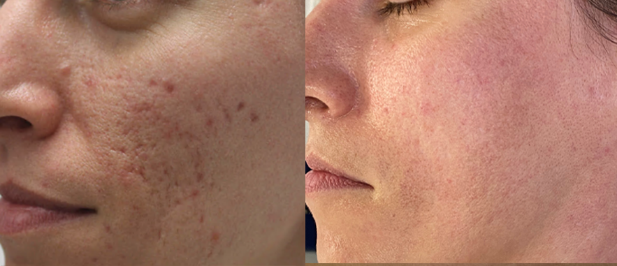 Red acne scars treatment cutis dermatology brisbane 4