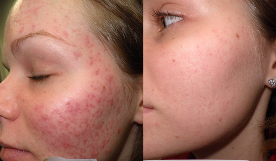 Red acne scars treatment cutis dermatology brisbane