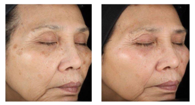 Retinoid peel