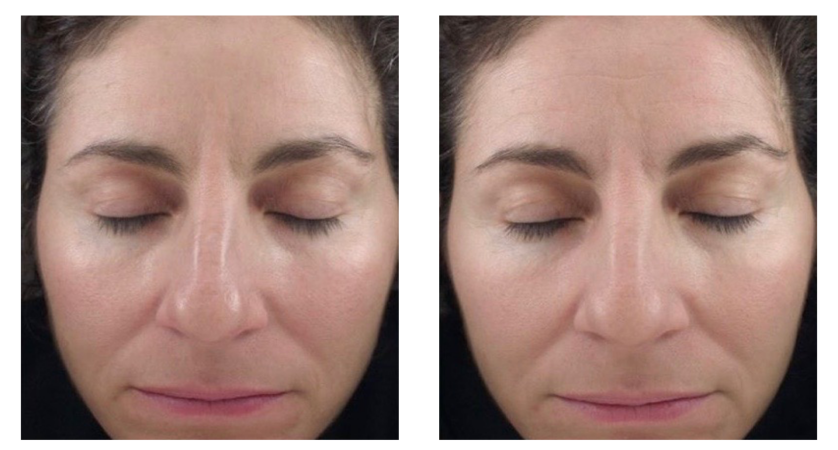 Retinol brisbane