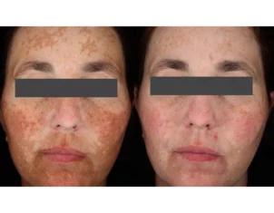 Skincare Treatment Cutis Dermatology Brisbane 2