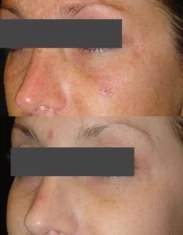 Skincare Treatment Cutis Dermatology Brisbane 27