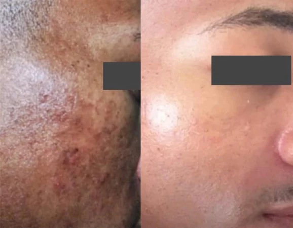 Skincare Treatment Cutis Dermatology Brisbane 31