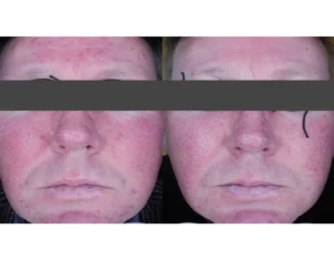 Skincare Treatment Cutis Dermatology Brisbane 4