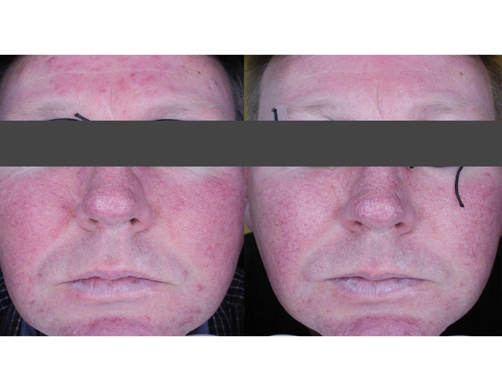 Skincare Treatment Cutis Dermatology Brisbane 4