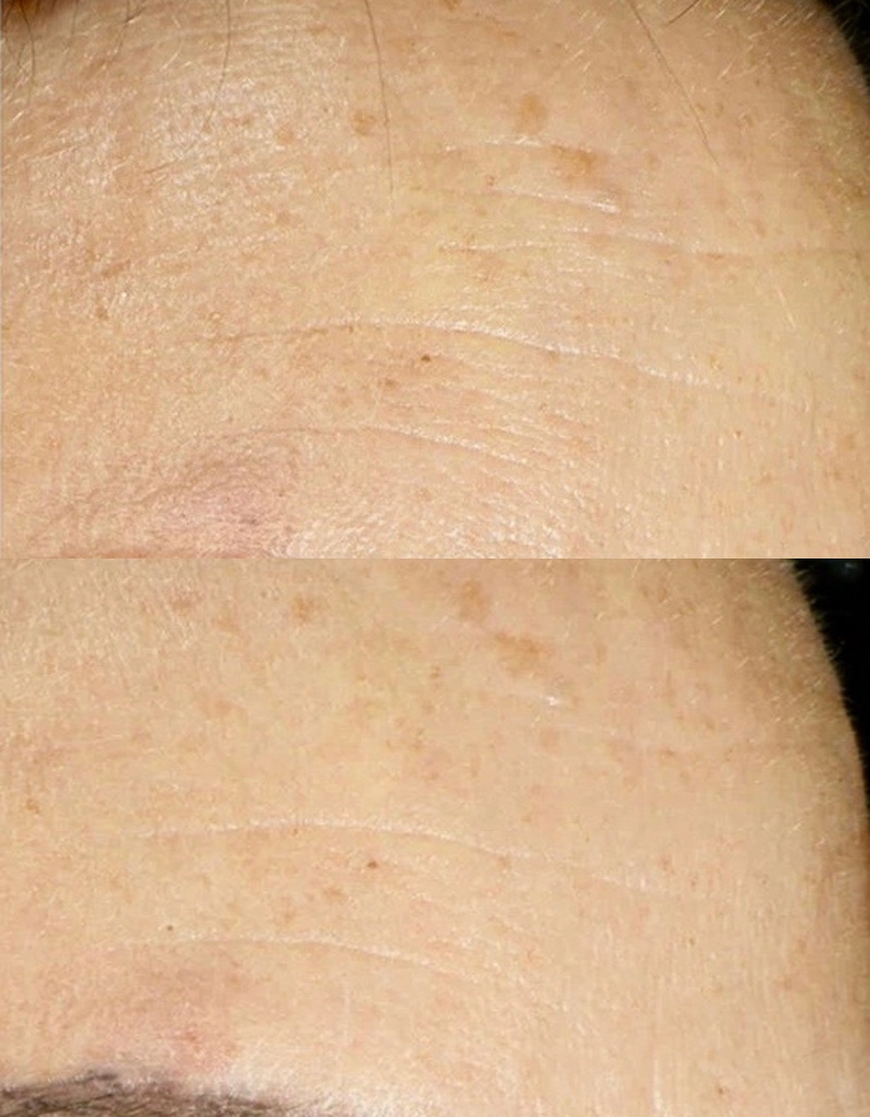 Skincare Treatment Cutis Dermatology Brisbane 49