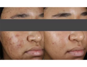Skincare Treatment Cutis Dermatology Brisbane 60