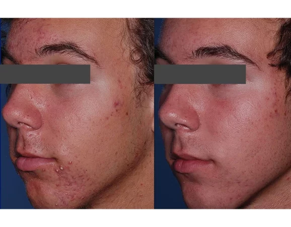 Skincare Treatment Cutis Dermatology Brisbane 66