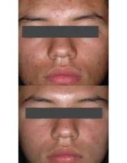 Skincare Treatment Cutis Dermatology Brisbane 67