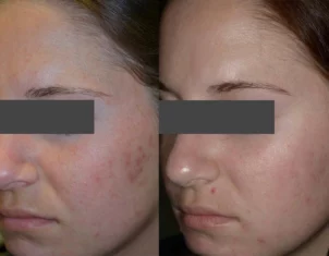 Skincare Treatment Cutis Dermatology Brisbane 69