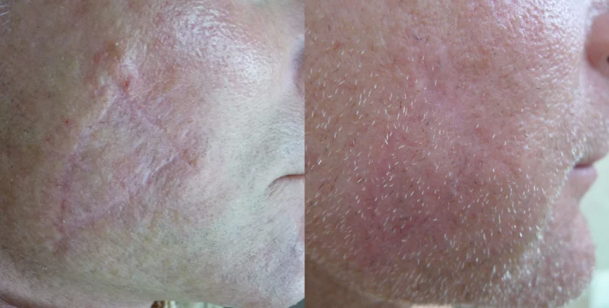 Surgical scars treatment cutis dermatology brisbane 12 scaled