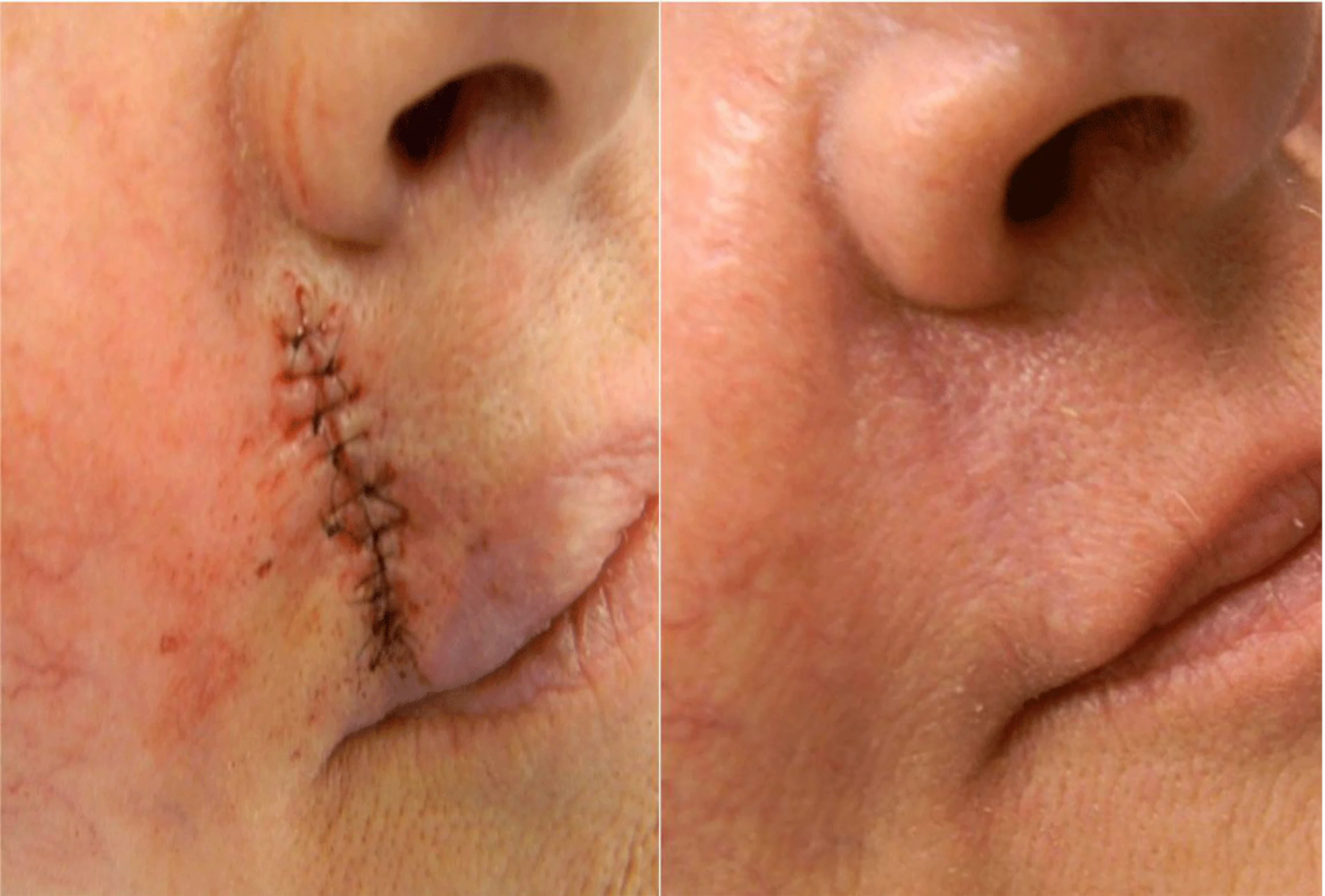Surgical scars treatment cutis dermatology brisbane 18 scaled